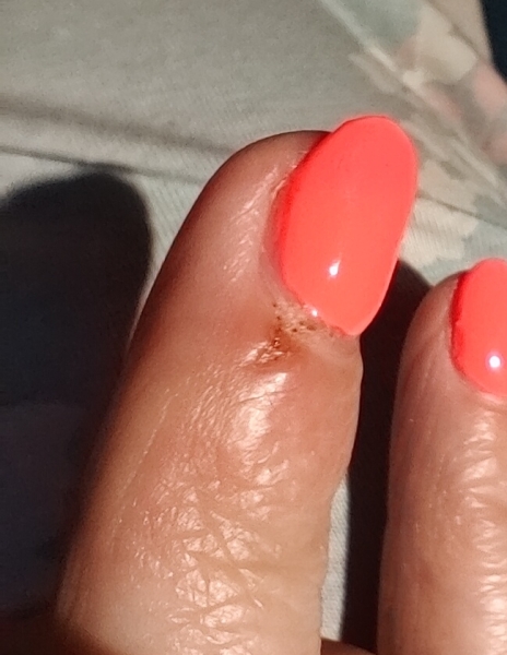 Wwyd. Potential infected finger day before holiday