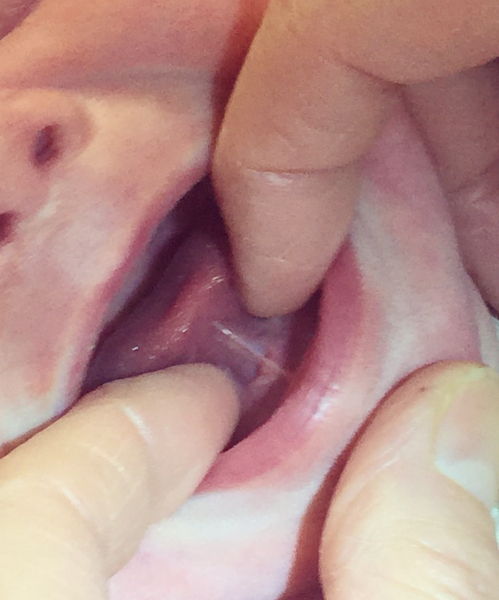 Feeding with a tongue tie