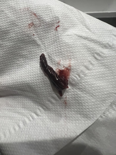 is this a normal period clot??! Warning pictures included!