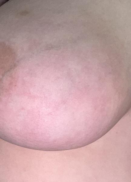 Breast pain