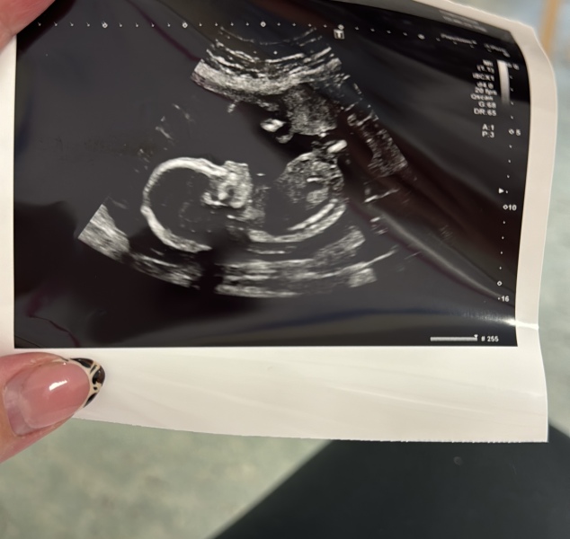 Boy or Girl?