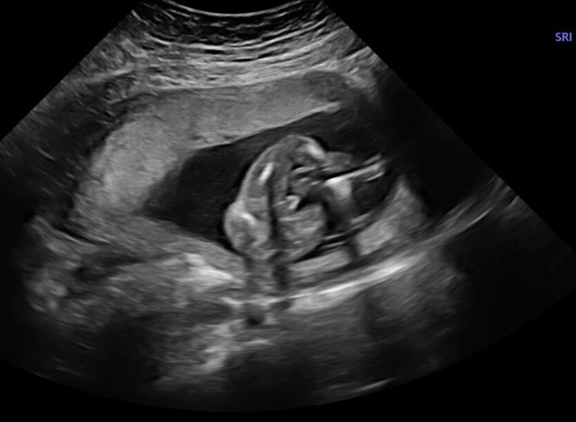 17 week gender scan says boy