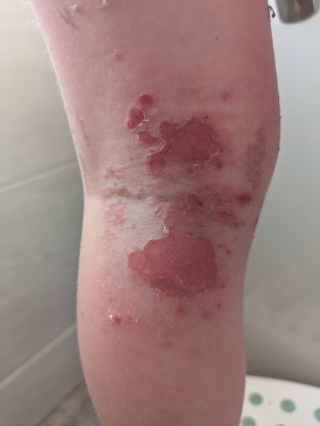 Infected bits getting worse?