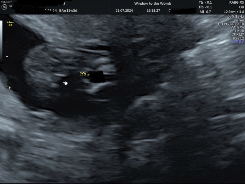 Anyone worried their private gender scan is wrong?