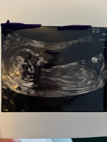 Nub theory 12 and 20 weeks