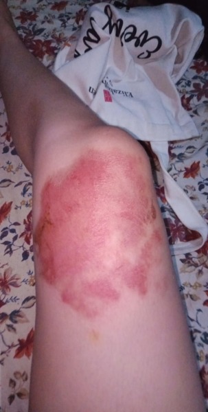 Will this 2nd degree burn leave a scar?