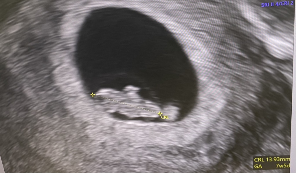 BFP after IVF - anyone want to join me in the wait for first scan?