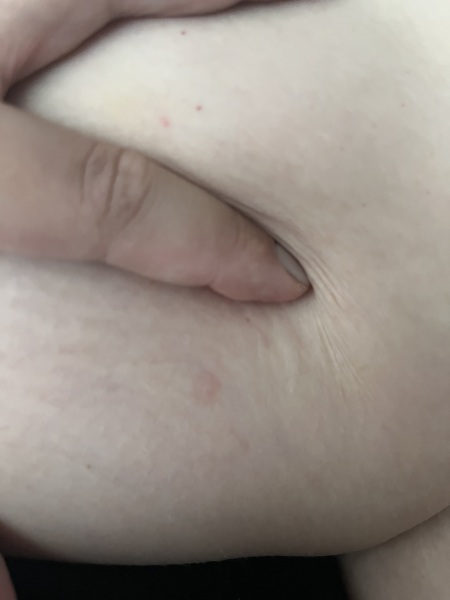 Red patch on upper thigh??