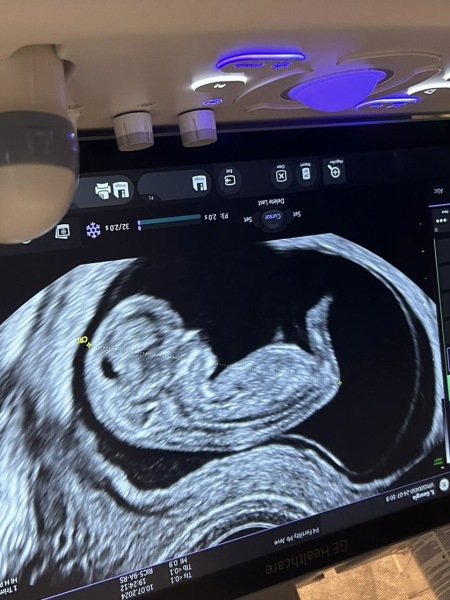12 week scan does it look ok?