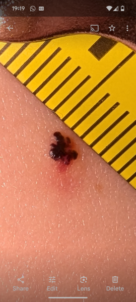 Could this be melanoma?