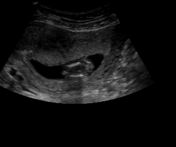 Gender scan told boy