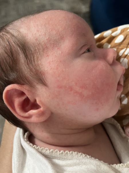 Is this baby acne? Please help!