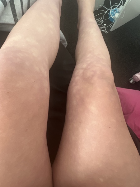 Blotchy legs at 39 weeks pregnant