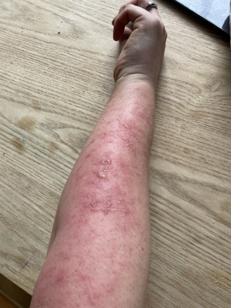 Nasty rash after gardening