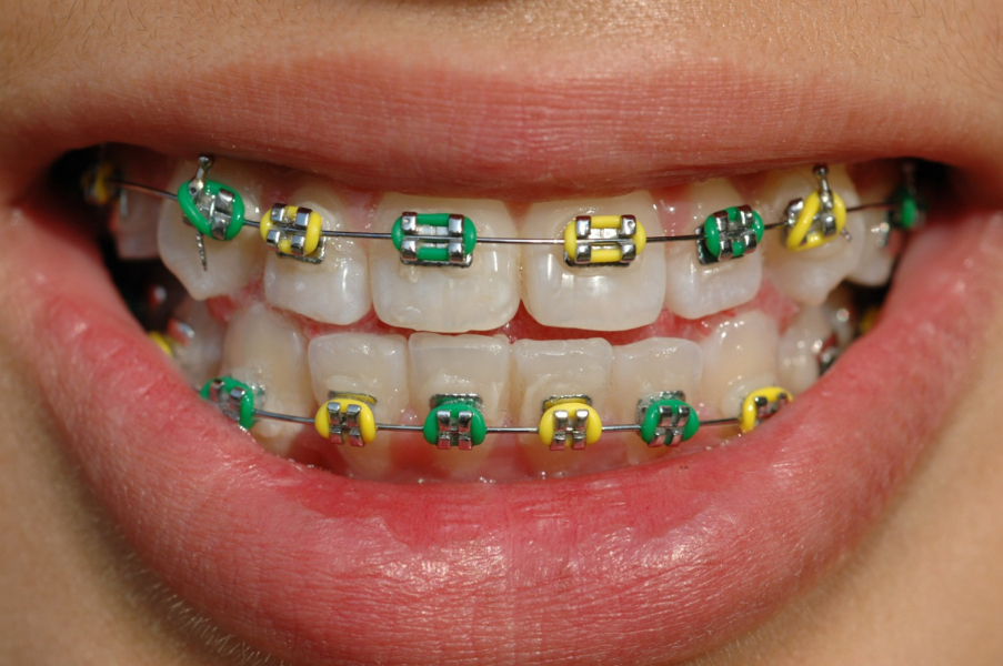 Colour braces on NHS?