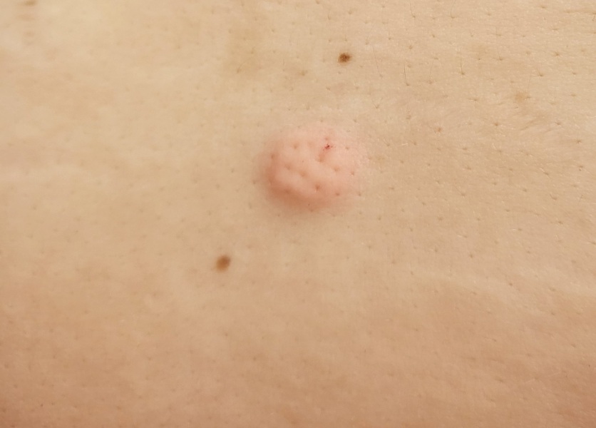 Injection site reaction, any advice please?