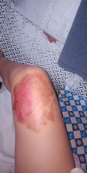 Will this burn leave a scar? Should I use a cream or oil? (Ugly) pic attached