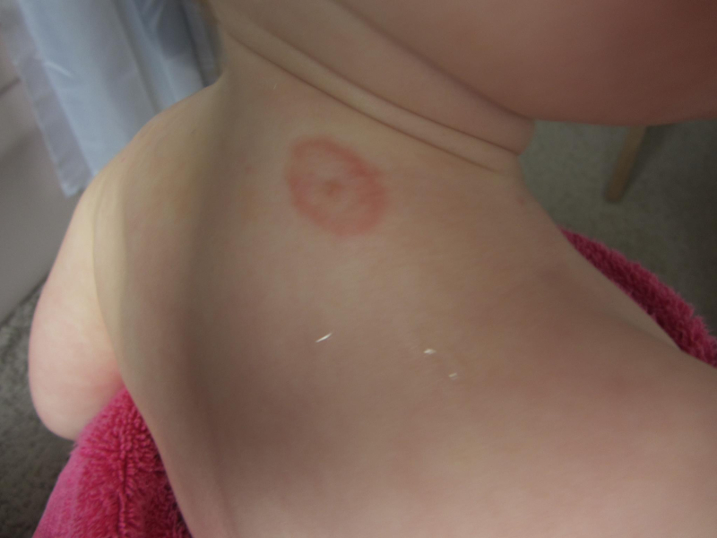 To be freaked out by a tick on my DD!