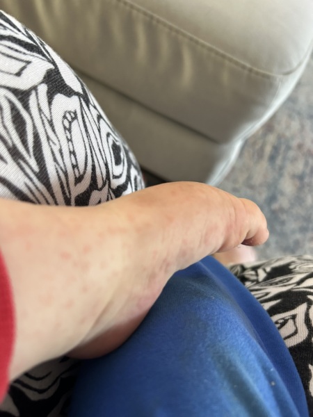 12 month old has a rash