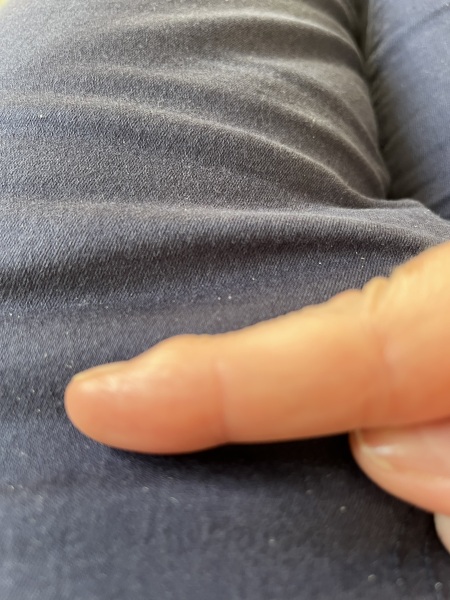 Osteoarthritis in finger joints