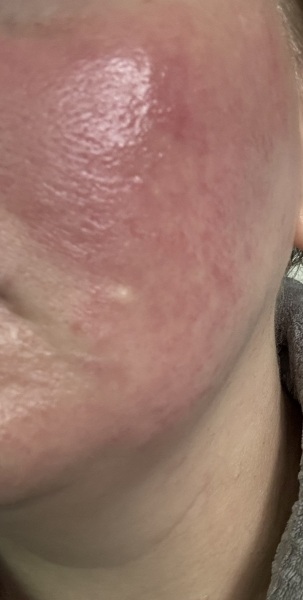 Rosacea?