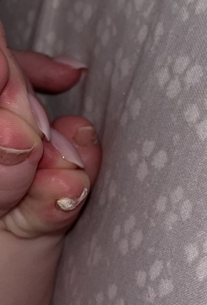 Toenail fungus cure?