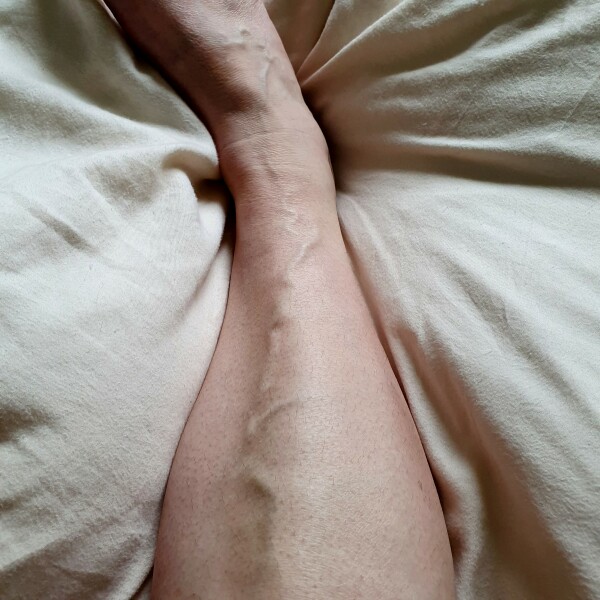 To think this is a varicose vein?