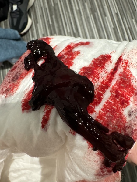 Irregular bleeding and clotting 6 Months after mmc