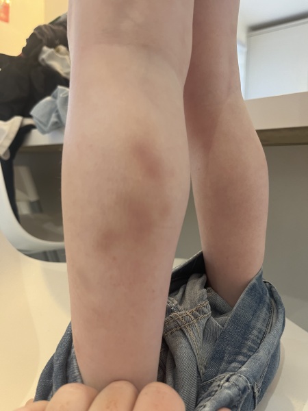 Bruising and nursery?
