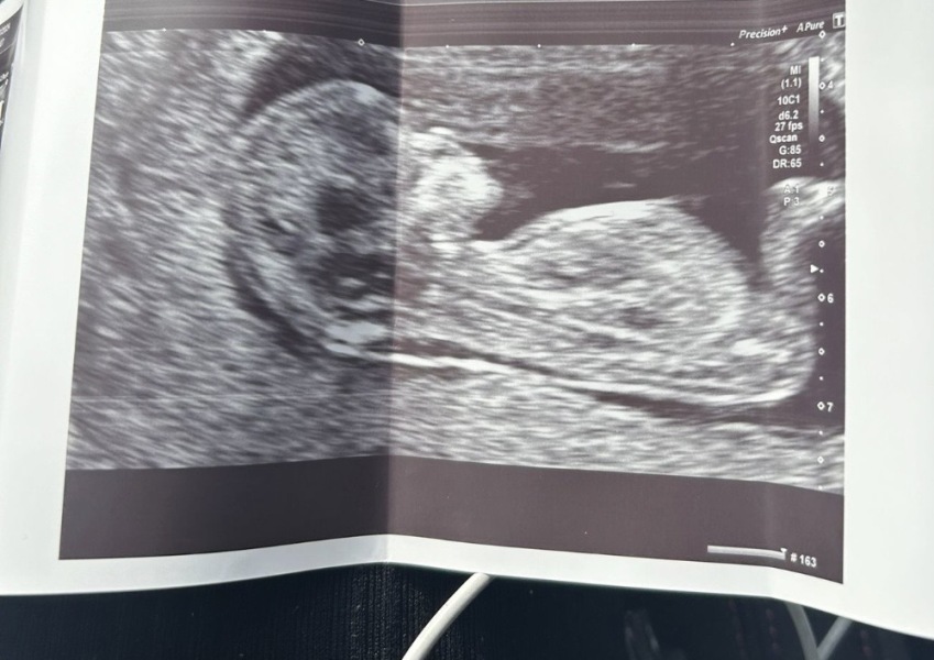 12 week scan does it look ok?
