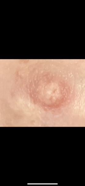 Nipple constantly white