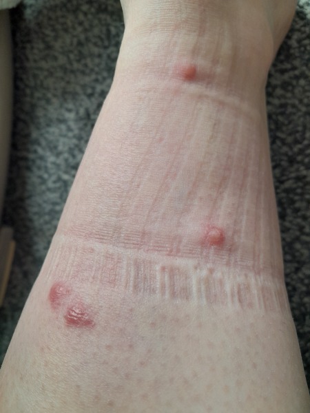 What the bloody hell is biting me!!!