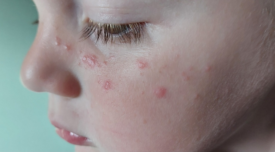 Opinions and experience on face rash