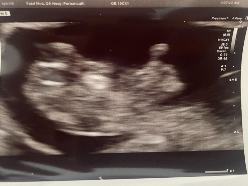 BFP after recent loss (Thread 2) 🌈