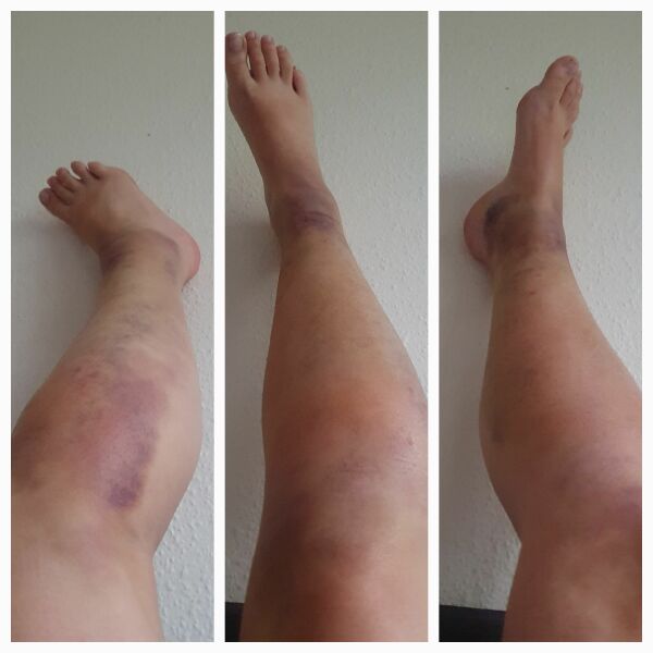 Mahoosive bruise on my leg