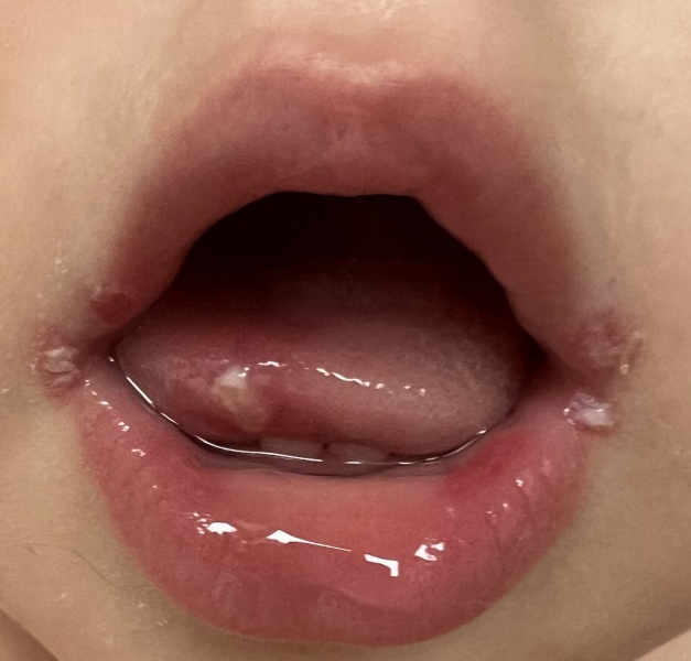 Is it possible that DC caught herpes from nursery?