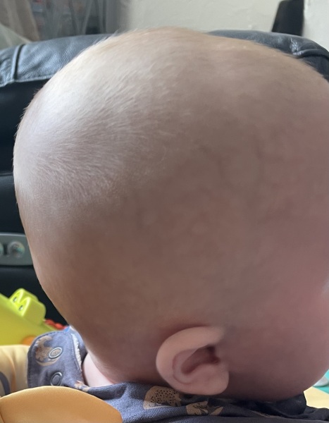 Flat head in my 4 month old. Is this severe??