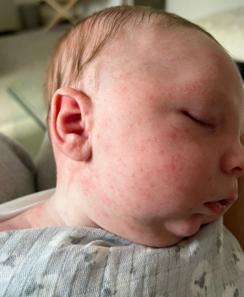 Unsure on new born baby face rash
