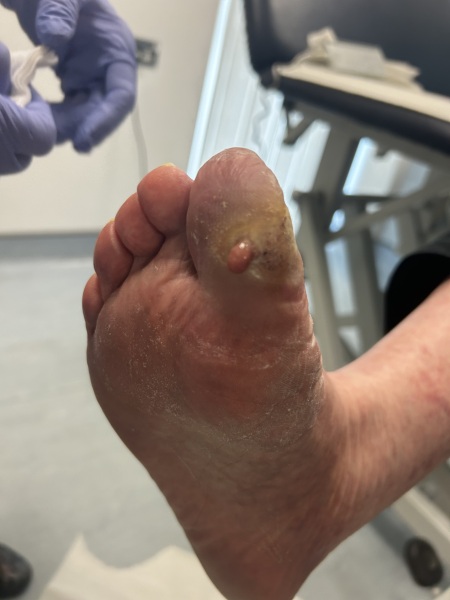 My mums toe