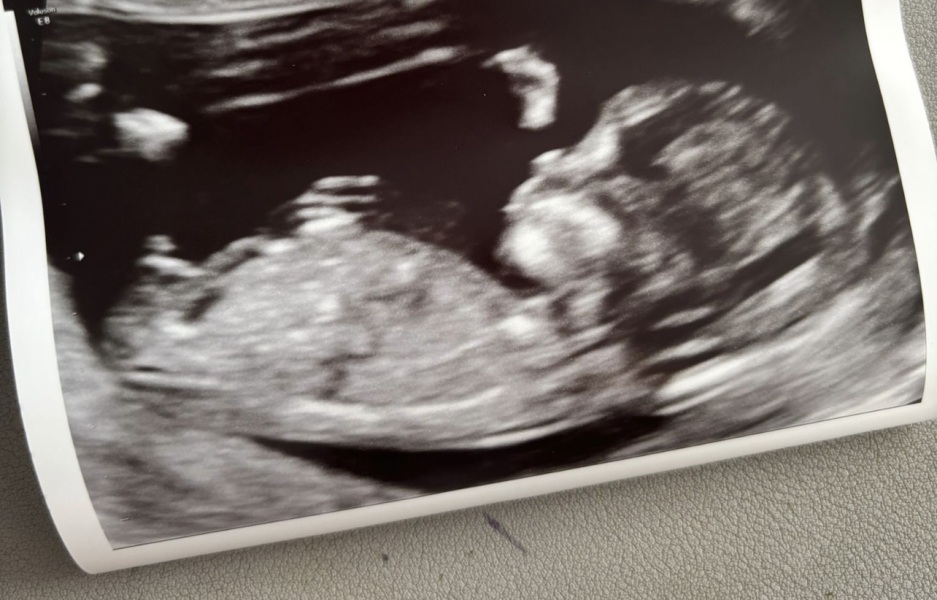 My friends scan (she approved me to do) what do we think she's having?