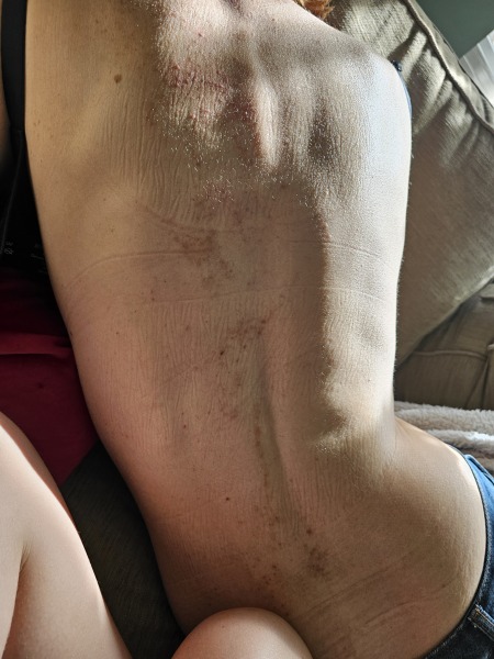 Thyroid dermopathy on back - with pictures