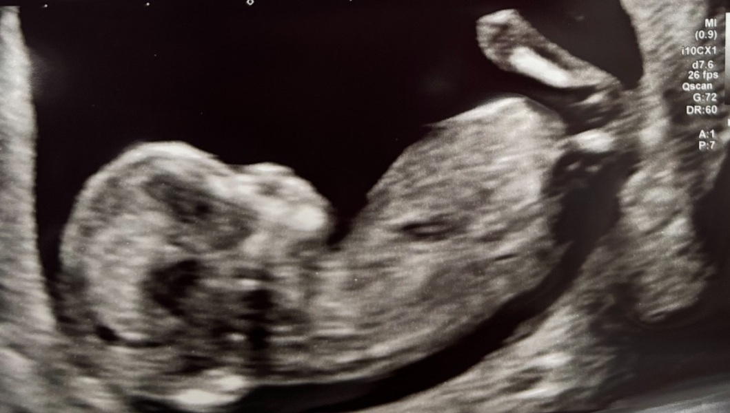 Boy or Girl