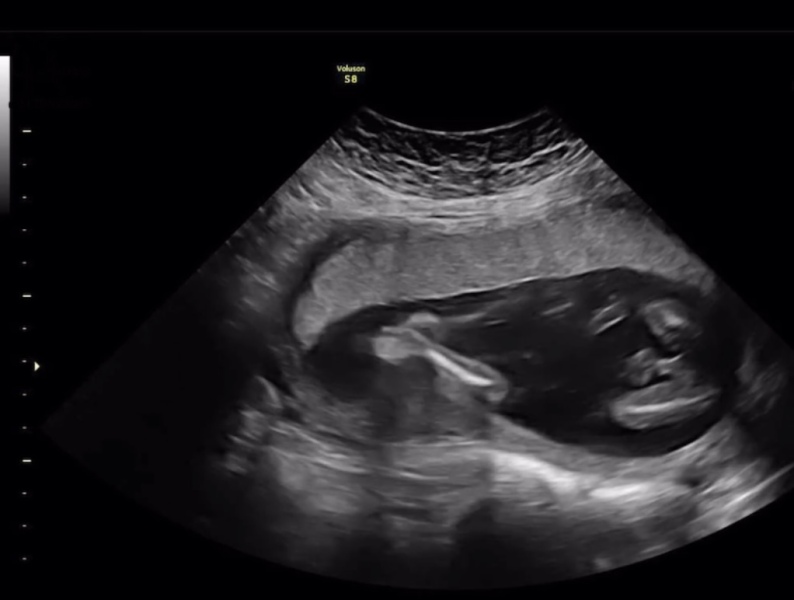 Boy parts on 17 week scan?