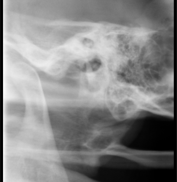 TMJ/Jaw issues