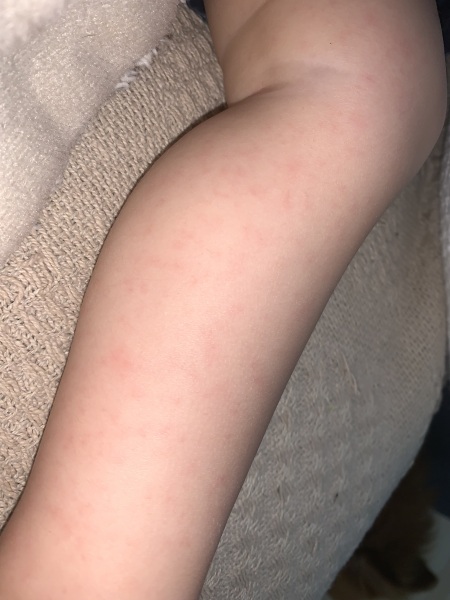 Rash on toddler’s legs
