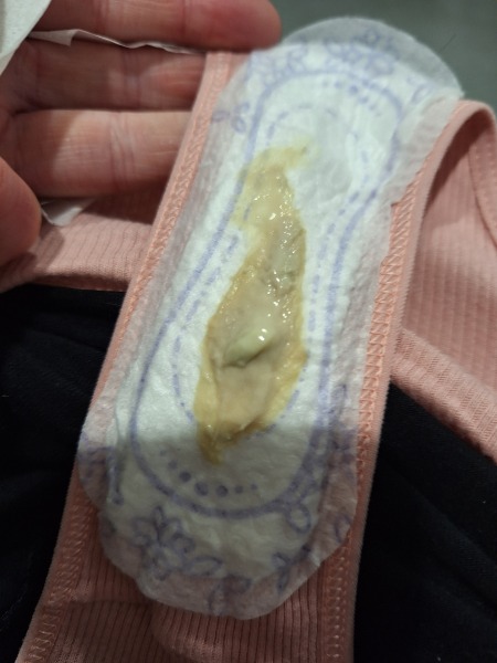 Mucus plug or not?