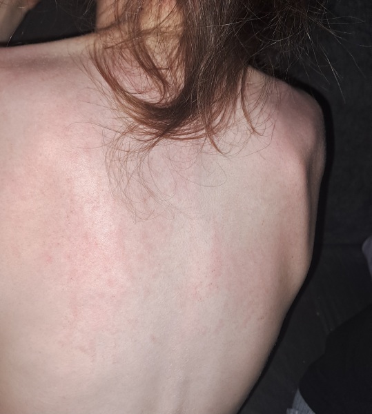 Do you think this could be Scarlet fever?