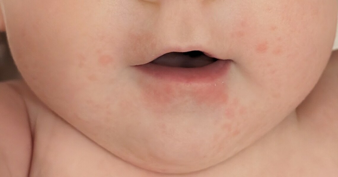 Does this look like an egg allergy?