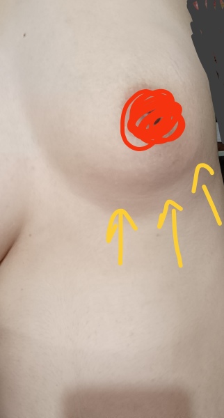 Breast dimpling