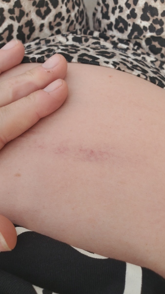 Banged belly on door handle - anti D?